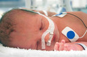 Síndrome da dificuldade respiratória dos recém-nascidos ou Doença da Membrana Hialina: como ela é?